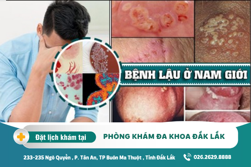 Cách chữa bệnh lậu Đắk Lắk - Triệu chứng bệnh lậu ở nam như thế nào?